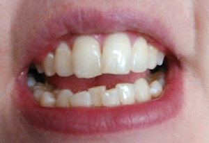 My teeth at the start, getting mad-cosy with each other up in there